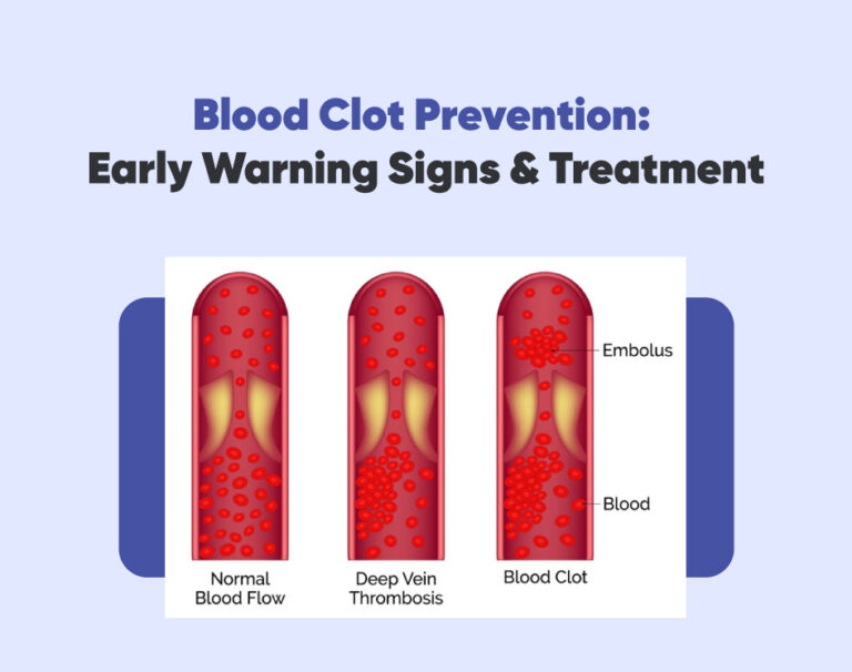 Blood Clot Prevention: Early Warning Signs & Treatment