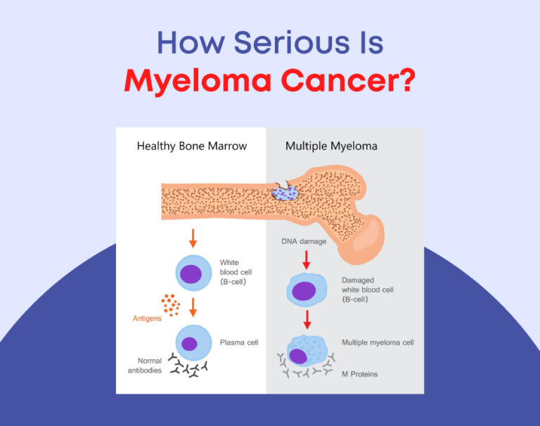 How Serious Is Myeloma Cancer?