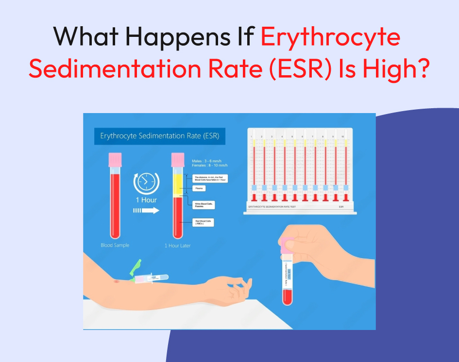 What Happens If Erythrocyte Sedimentation Rate (esr) Is High?