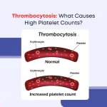 Thrombocytosis: What Causes High Platelet Counts?