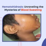 Hematohidrosis: Unraveling the Mysteries of Blood Sweating