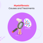 Myelofibrosis: Causes and Treatments