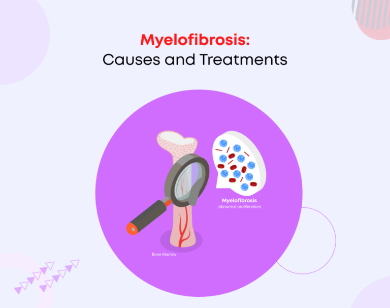 Myelofibrosis: Causes and Treatments