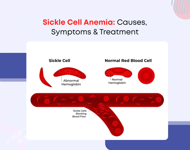 Sickle Cell Anemia: Causes, Symptoms & Treatment