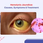 Hemolytic Jaundice: Causes, Symptoms & Treatment