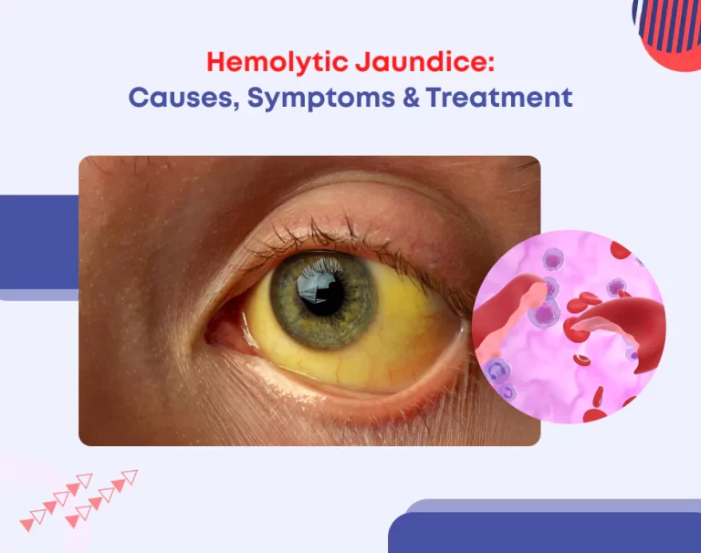 Hemolytic Jaundice: Causes, Symptoms & Treatment