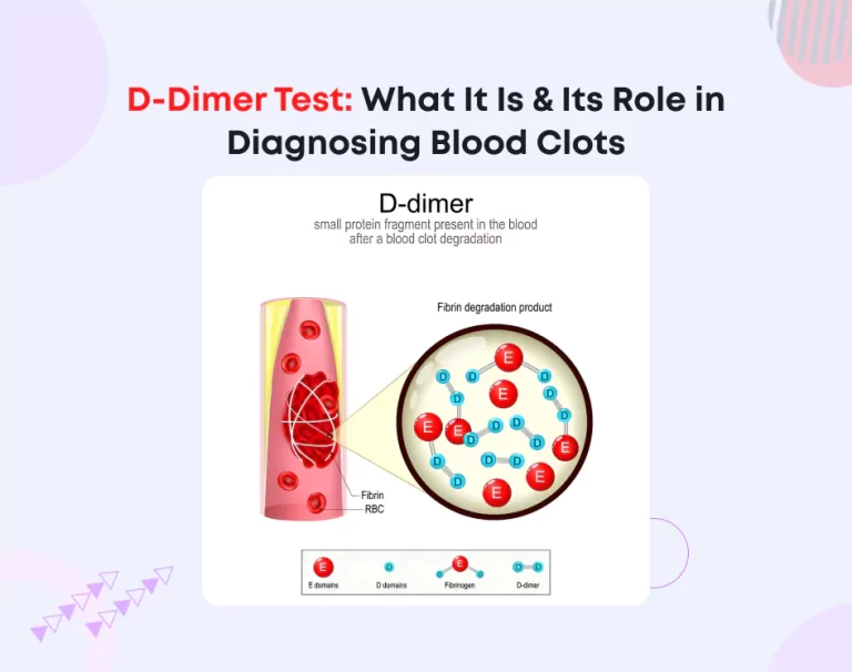 D-Dimer Test: What It Is & Its Role in Diagnosing Blood Clots