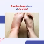 Swollen Legs A sign of Anemia