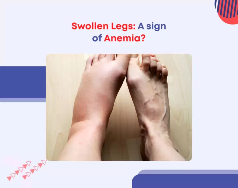 Swollen Legs A sign of Anemia