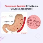 Pernicious Anemia: Symptoms, Causes & Treatment